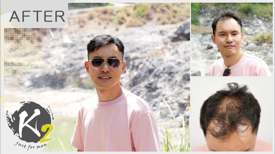 掉髮十年不再遮掩：企業講師體驗男性髮片的勇氣重生