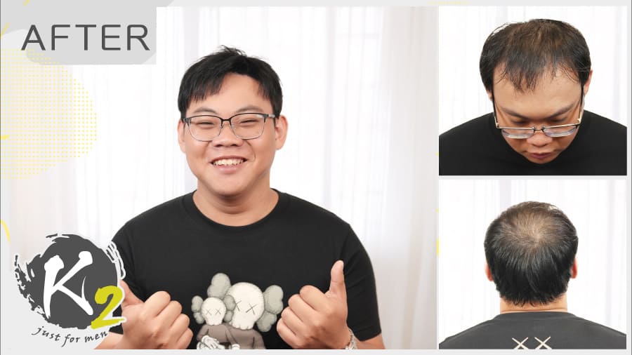 25 歲銀行員掉髮，靠髮片逆轉專業形象